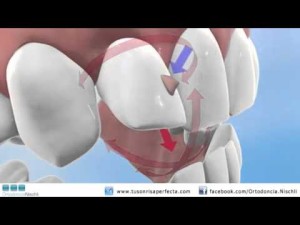 Orthodontie invisible : invisalign
